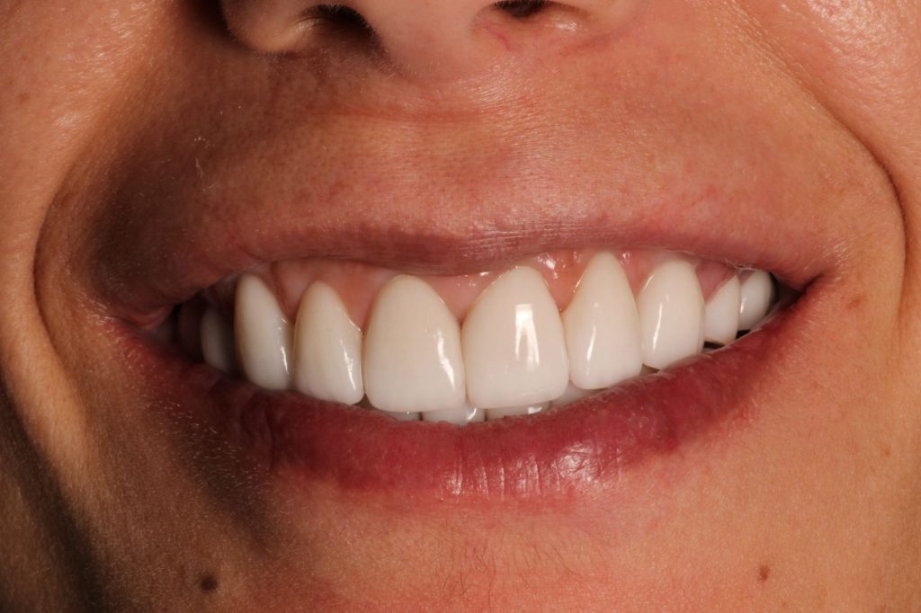 imagen tratamientos restauraci'on completa